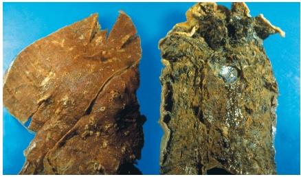A normal lung (left) and the lung of a cigarette smoker. (Reproduced by permission of Photo Researchers, Inc.)