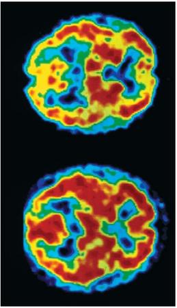 A colored positron emission tomography (PET) scan of the brain of an AIDS patient suffering from dementia (top). Compared to the scan of a normal brain (bottom), the dark areas of the brain in the AIDS patient are much smaller, reflecting a decrease in the brain's ability to function. (Reproduced by permission of Photo Researchers, Inc.)