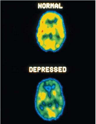 Positron emission tomography scans comparing a normal brain with that of someone with a depressed mental disorder. (Reproduced by permission of Photo Researchers, Inc.)