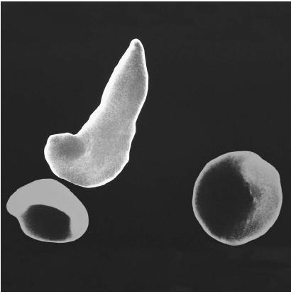 NORMAL RED BLOOD CELLS (BOTTOM) AND SICKLE CELL (TOP). SICKLE CELL ANEMIA IS A FATAL DISEASE BROUGHT ABOUT BY A SINGLE MISTAKE IN AMINO ACID SEQUENCING. WHEN RED BLOOD CELLS RELEASE OXYGEN TO THE TISSUES, THEY FAIL TO RE-OXYGENATE NORMALLY AND INSTEAD TWIST INTO THE SHAPE THAT GIVES SICKLE CELL ANEMIA ITS NAME, CAUSING OBSTRUCTION OF THE BLOOD VESSELS. (Photograph by Dr. Gopal Murti. National Audubon Society Collection/Photo Researchers, Inc. Reproduced by permission.)