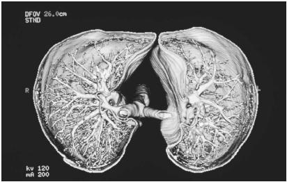 COMPUTERIZED TOMOGRAPHIC VIEW OF THE LUNGS, SHOWING THE TRACHEA (CENTER) SPLITTING TO FORM THE TWO MAIN BRONCHI, WHICH LEAD TO THE LUNGS. INSIDE THE LUNGS, MANY BRANCHING BRONCHI TERMINATE IN ALVEOLI, AIR SACS WHERE GAS EXCHANGE TAKES PLACE. (&#xA9; BSIP/Gems Europe/Photo Researchers. Reproduced by permission.)
