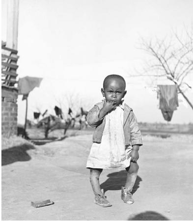 DURING THE GREAT DEPRESSION, A CHILD IN THE SOUTHERN UNITED STATES SHOWS SIGNS OF RICKETS, STEMMING FROM VITAMIN DDEFICIENCY. UNDER THE INFLUENCE OF THIS DEBILITATING AND DISFIGURING DISEASE, THE LEGS BECOME BOWED BY THE WEIGHT OF THE BODY, AND THE WRISTS AND ANKLES THICKEN. (&#xA9; Marion Post Wolcott/Corbis. Reproduced by permission.)