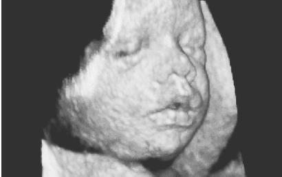 ULTRASOUND IMAGE OF A 30-WEEK-OLD FETUS. BY THE EIGHTEENTH WEEK OF PREGNANCY, ULTRASOUND TECHNOLOGY CAN DETECT MANY STRUCTURAL ABNORMALITIES, SUCH AS SPINA BIFIDA, HEART AND KIDNEY DEFECTS, AND HARELIP. (© BSIP/Kretz Technik/Photo Researchers. Reproduced by permission.)