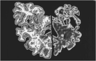 COMPUTER GRAPHIC OF THE BRAIN OF AN ALZHEIMER PATIENT (LEFT) COMPARED WITH A NORMAL BRAIN (RIGHT). ALZHEIMER&#x0027;S DISEASE SHRINKS THE BRAIN, WHICH SHOWS SIGNS OF THE DEGENERATION OF NERVE CELLS, TANGLED PROTEIN FILAMENTS, AND LESIONS CAUSED BY ACCUMULATION OF BETA-AMYLOID PROTEIN. (Photograph by Alfred Pasieka. Photo Researchers, Inc. Reproduced by permission.)