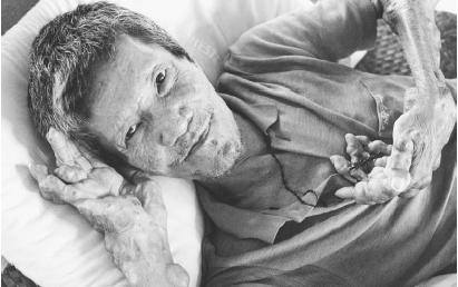 LEPROSY, CAUSED BY THE BACILLUS MYCOBACTERIUM LEPRAE, BRINGS ABOUT A GRADUAL WITHERING AWAY OF BODY PARTS. THERE ARE SOME TWO MILLION CASES OF THE DISEASE WORLDWIDE, PRIMARILY IN THE UNDERDEVELOPED NATIONS OF ASIA, AFRICA, AND LATIN AMERICA. (© Paul A. Souders/Corbis. Reproduced by permission.)