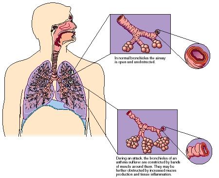 A comparison of normal bronchioles and those of an asthma sufferer. (Reproduced by permission of The Gale Group.)