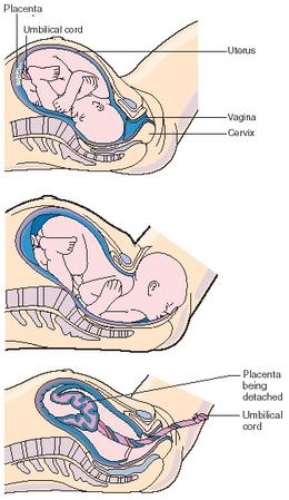 The three stages of birth: dilation of the cervix, expulsion of the fetus, and expulsion of the placenta. (Reproduced by permission of The Gale Group.)