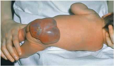 An infant with spina bifida. (Reproduced by permission of Photo Researchers, Inc.)