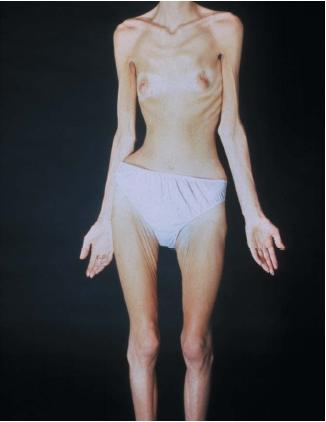 A woman suffering from anorexia nervosa. (Reproduced by permission of Photo Researchers, Inc.)
