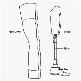 A typical above-the-knee prosthesis. (Reproduced by permission of The Gale Group.)