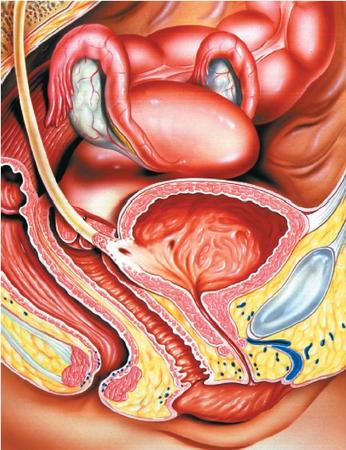 Illustration of the female reproductive system. The vagina (lower center) is a ribbed muscular canal that ends internally at the cervix, or neck of the uterus. The uterus (upper center) is a pear-shaped, hollow, muscular organ in which a fetus develops during pregnancy. Ovaries (on either side of the uterus) pass their eggs into feathery ducts that lead to the uterus through fallopian tubes. (Reproduced by permission of Custom Medical Stock Photo, Inc.)