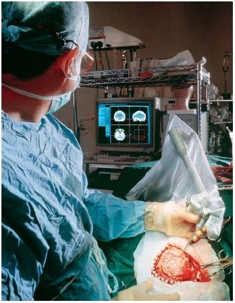 A neurosurgeon using a computer-controlled robot arm to remove a tumor from a patient's brain. (Reproduced by permission of Photo Researchers, Inc.)
